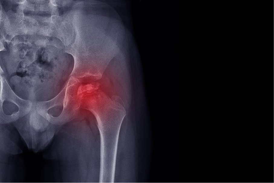 Legg-Calve-Perthes Disease of the hip