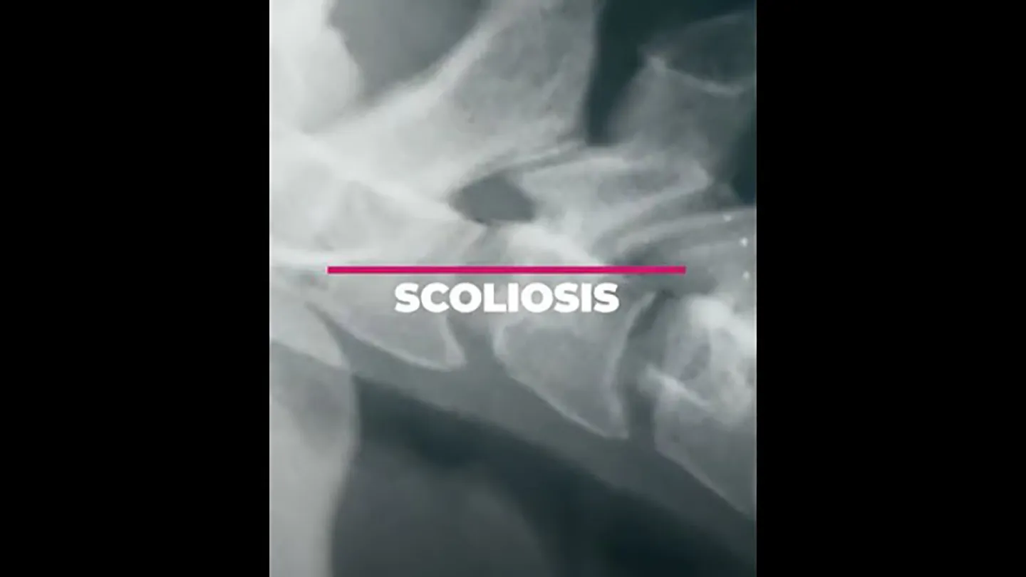 What’s Your Child’s Risk for Scoliosis?