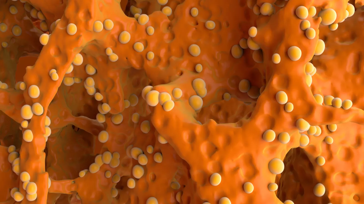 Bone Cancer Illustration