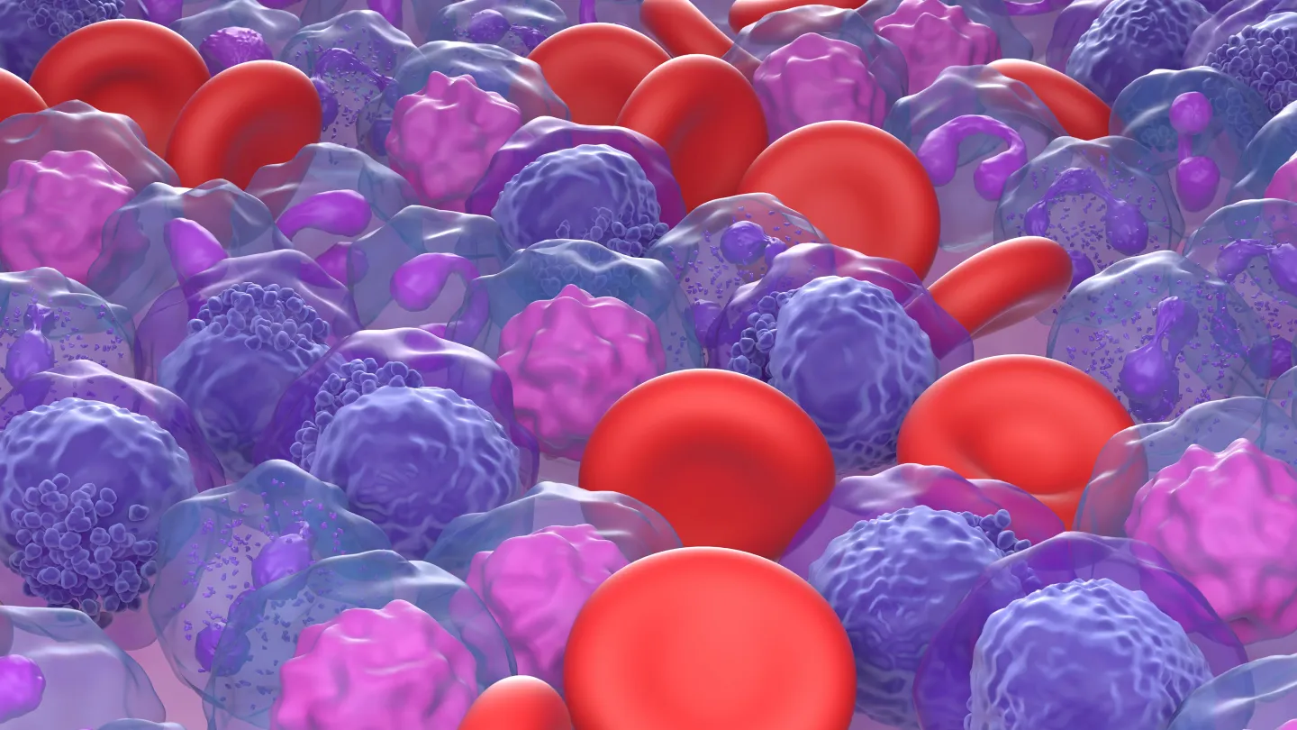 Acute myeloid leukemia, illustration