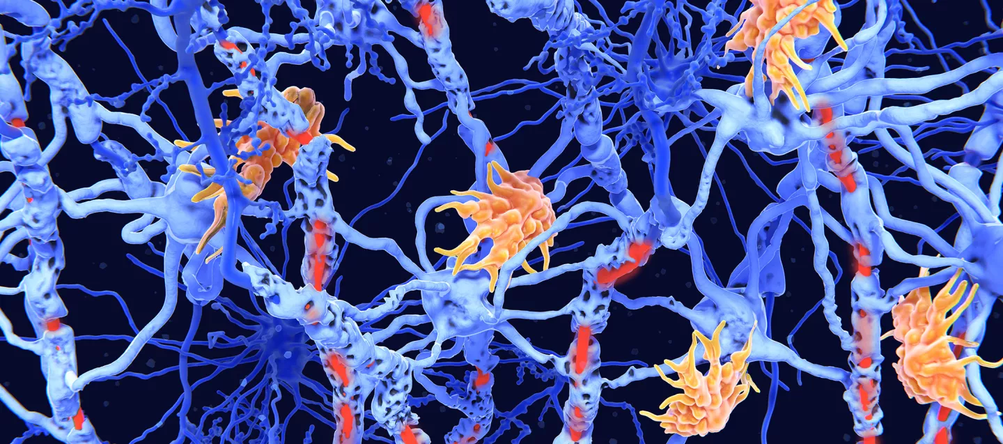 Illustration of Nerve damage in multiple sclerosis