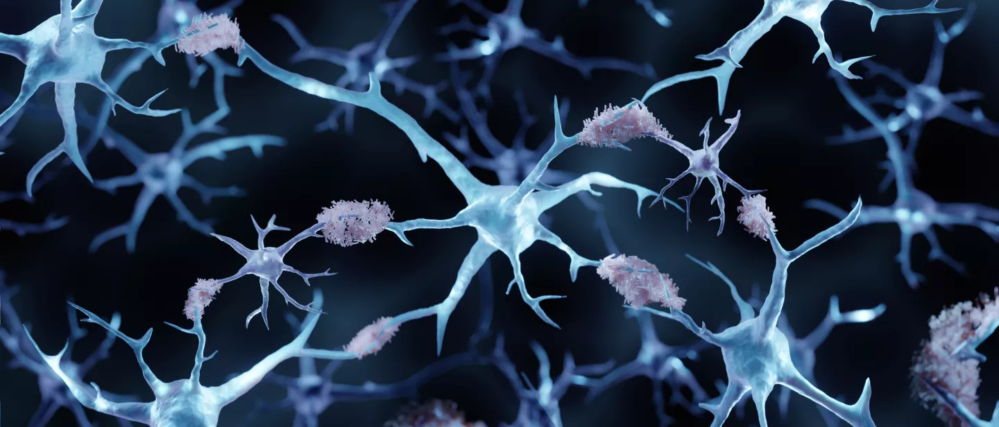 3d illustration showing amyloid plaques in Alzheimer's disease