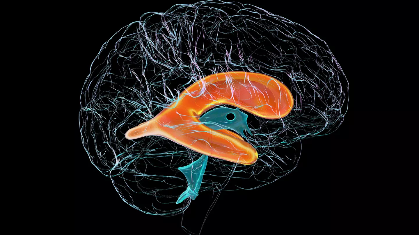 Preventing Hydrocephalus in Premature Infants
