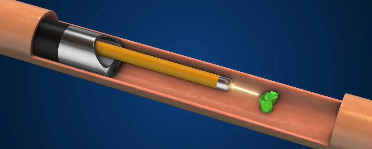 Illustration of kidney stone laser removal