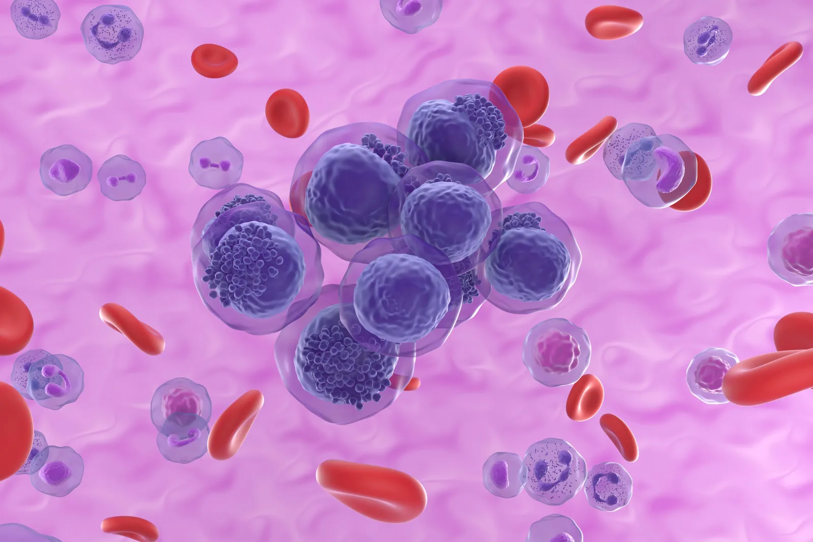 Acute myeloid leukemia, illustration