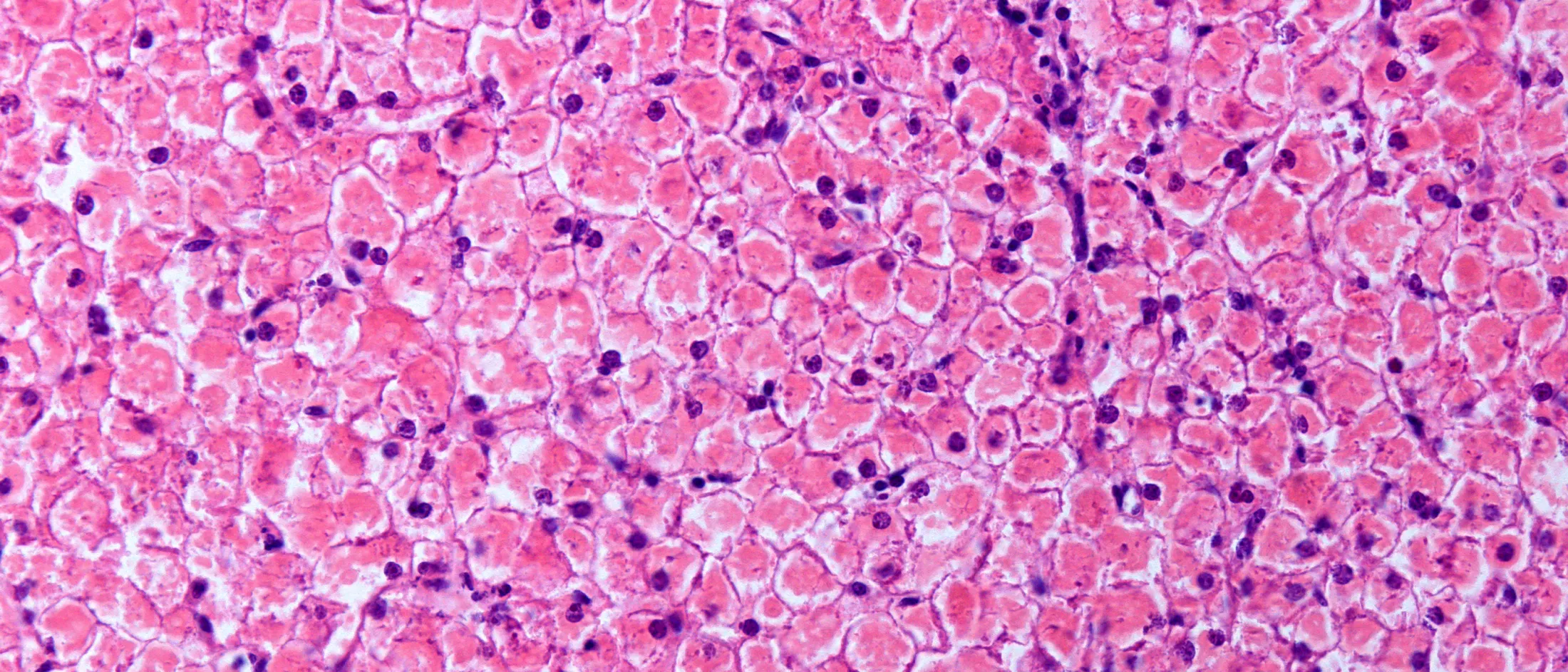 Human liver. Glycogenosis.