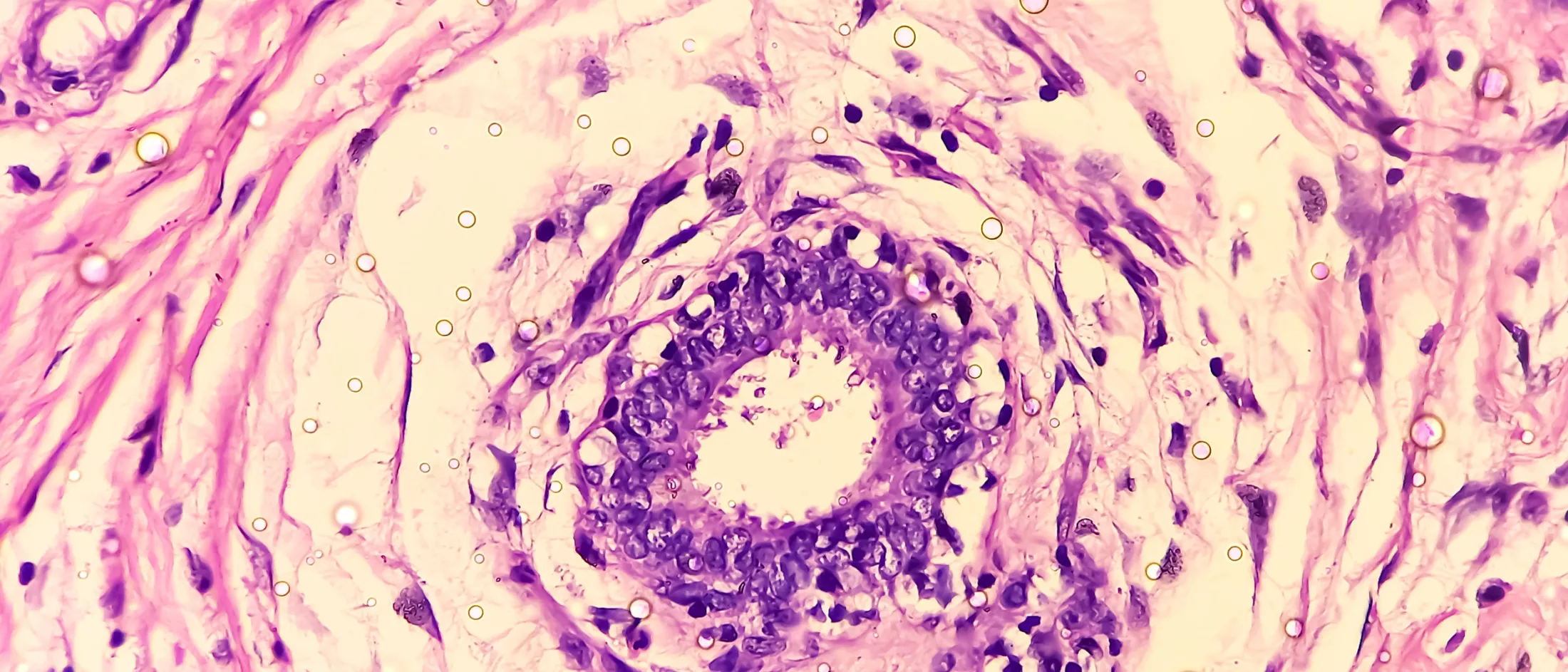 Microscopic image of Hidradenitis suppurativa in axillary mass tissues