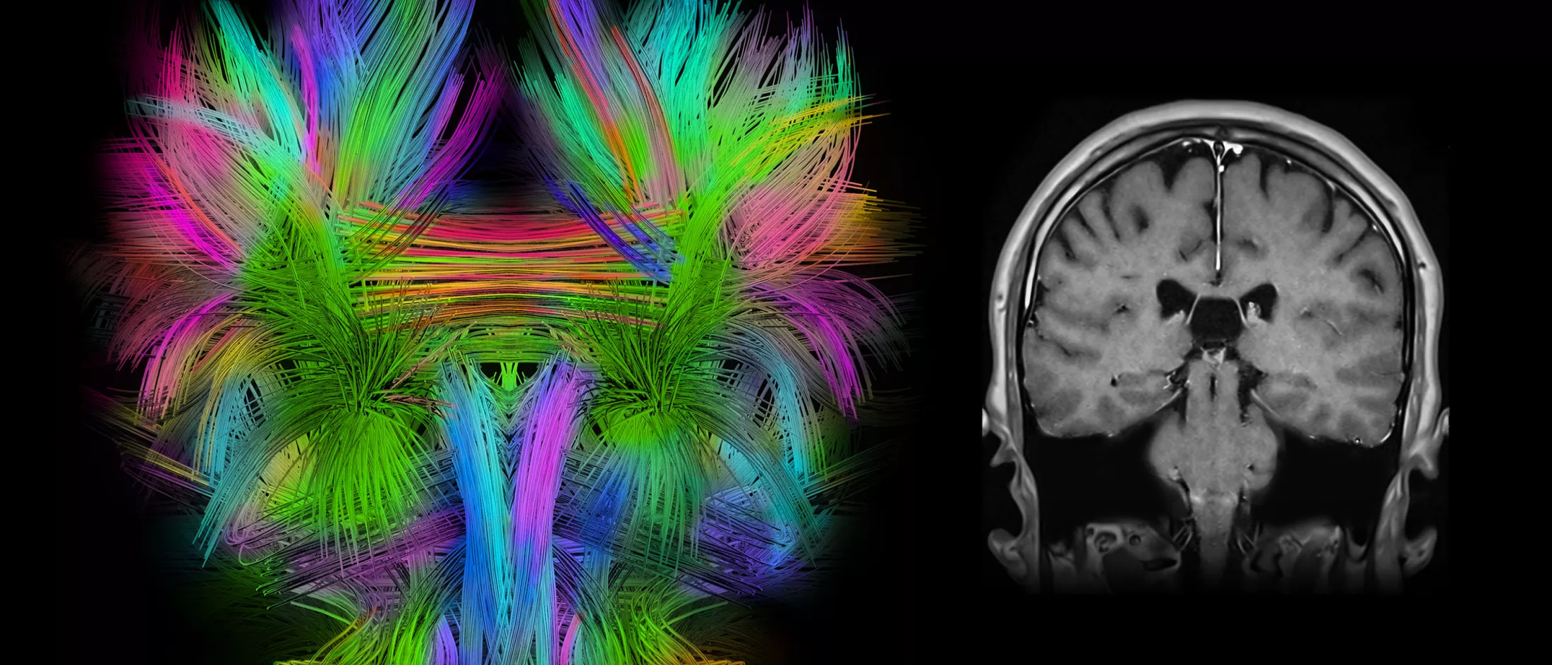A scan of the brain showing a movement disorder
