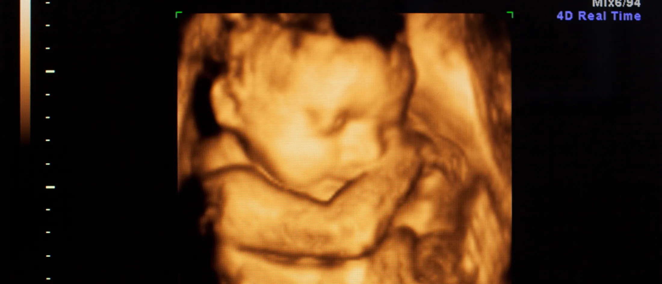 4D ultrasound scan showing a detailed image of a fetus with its arm raised near its face.