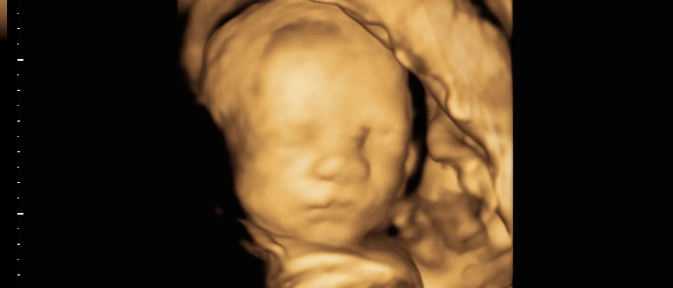 3D ultrasound scan of a fetus showing facial features in utero.