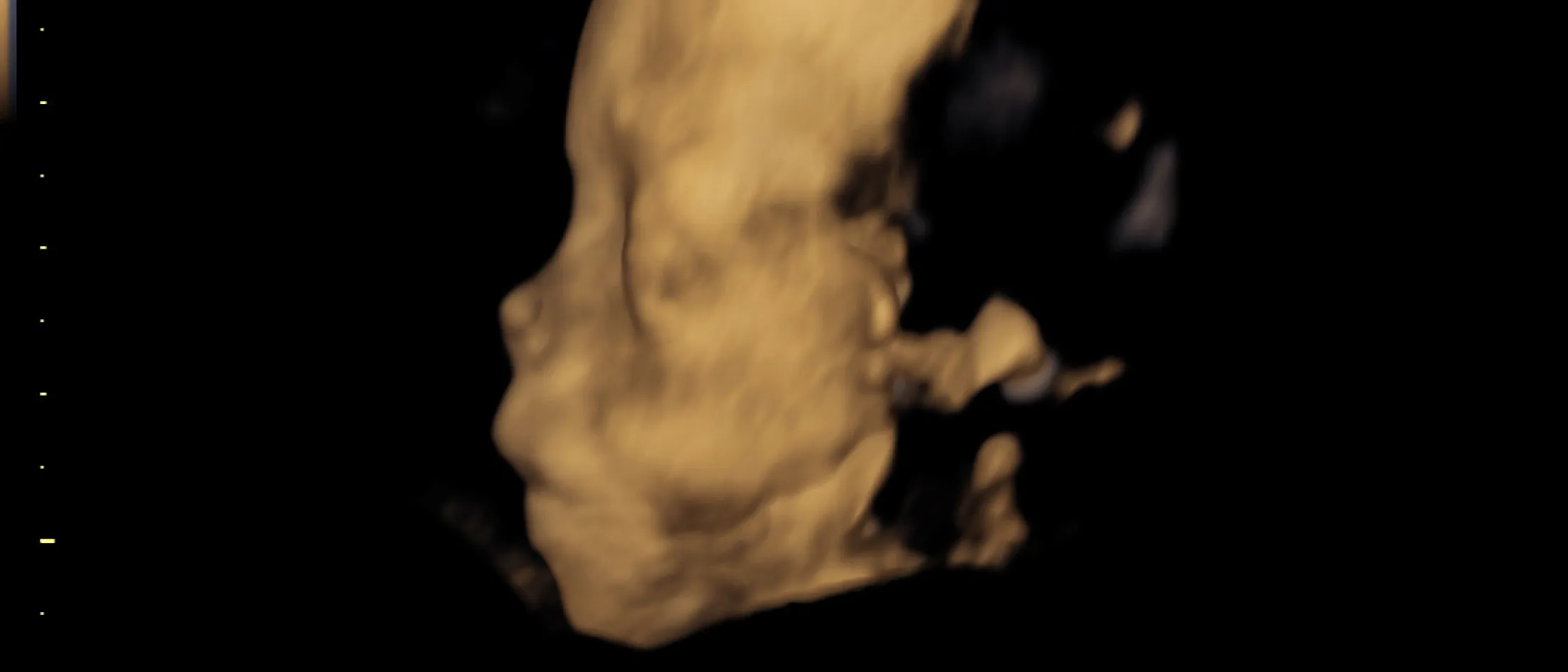 3D ultrasound image of a developing fetus at 20 weeks gestation, showing facial features in profile.