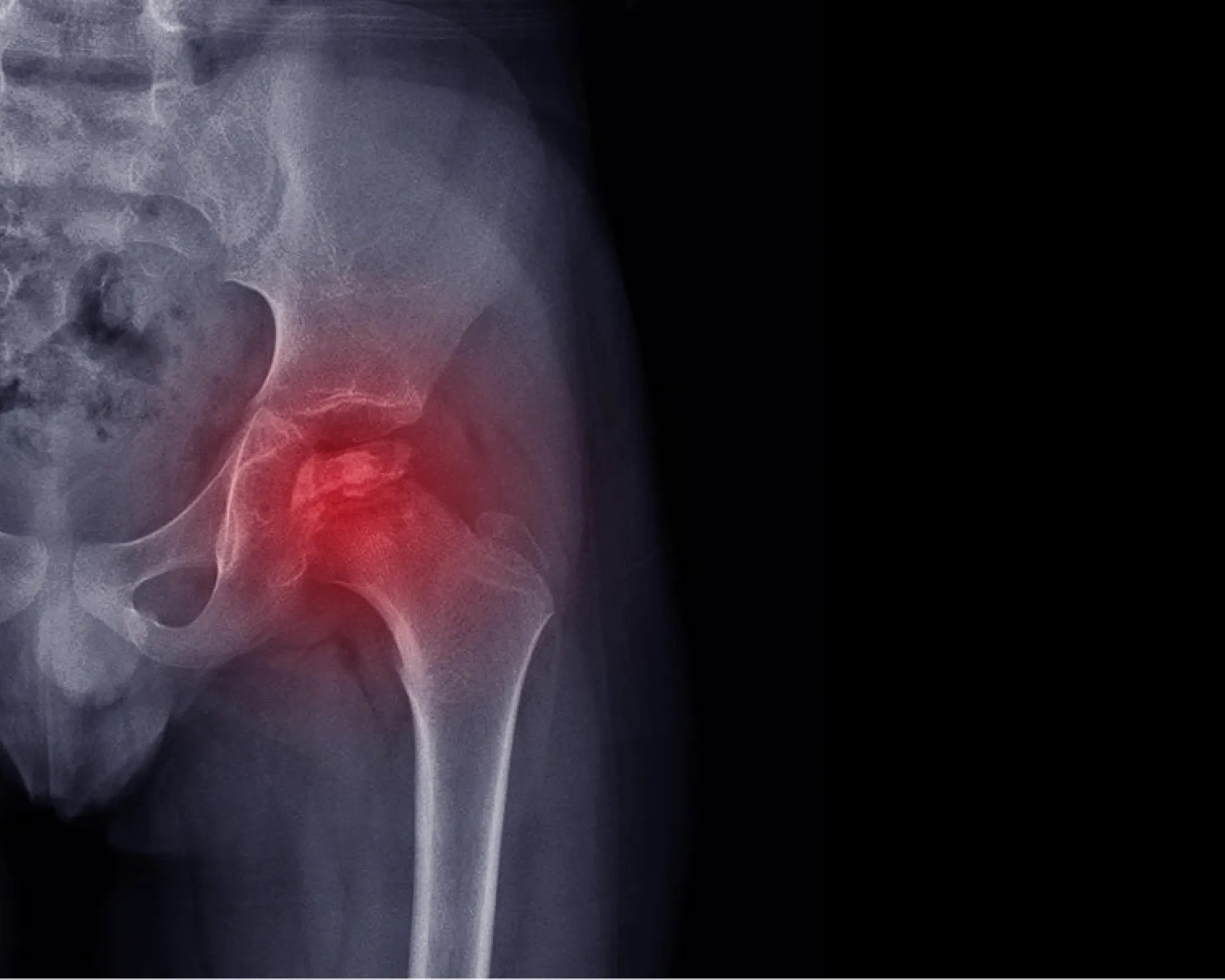 Legg-Calve-Perthes Disease of the hip