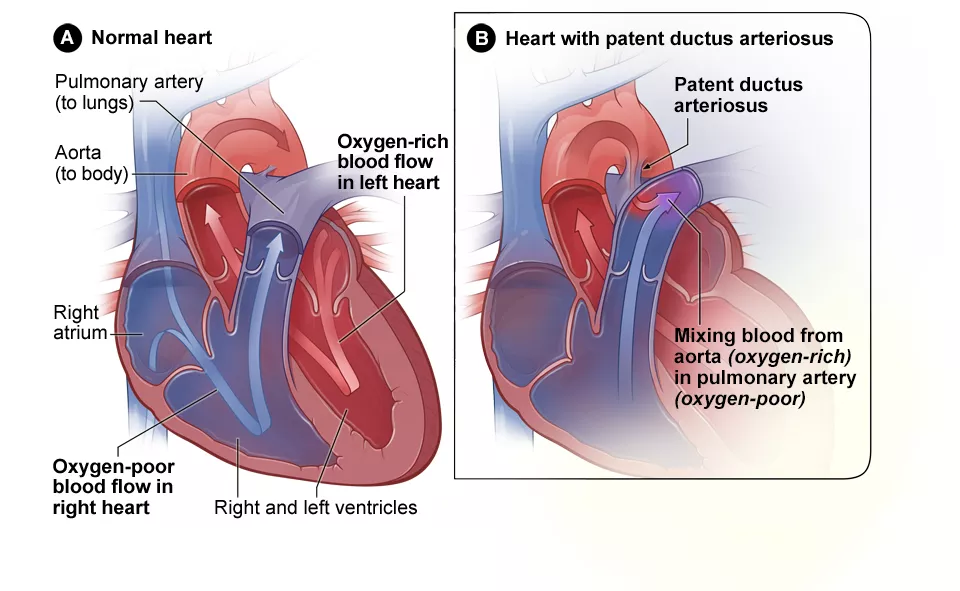 patent_ductus_arteriosus