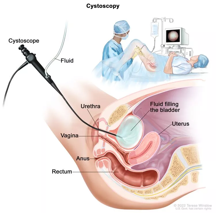 Cystoscopy