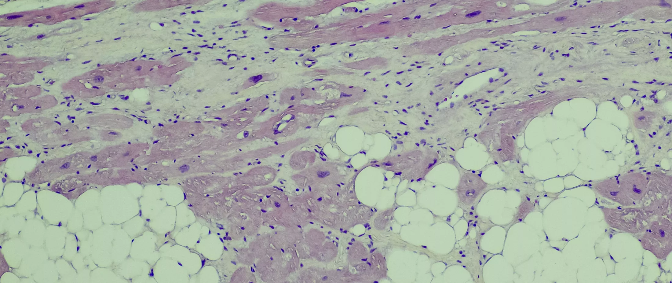 Arrhythmogenic right ventricular cardiomyopathy