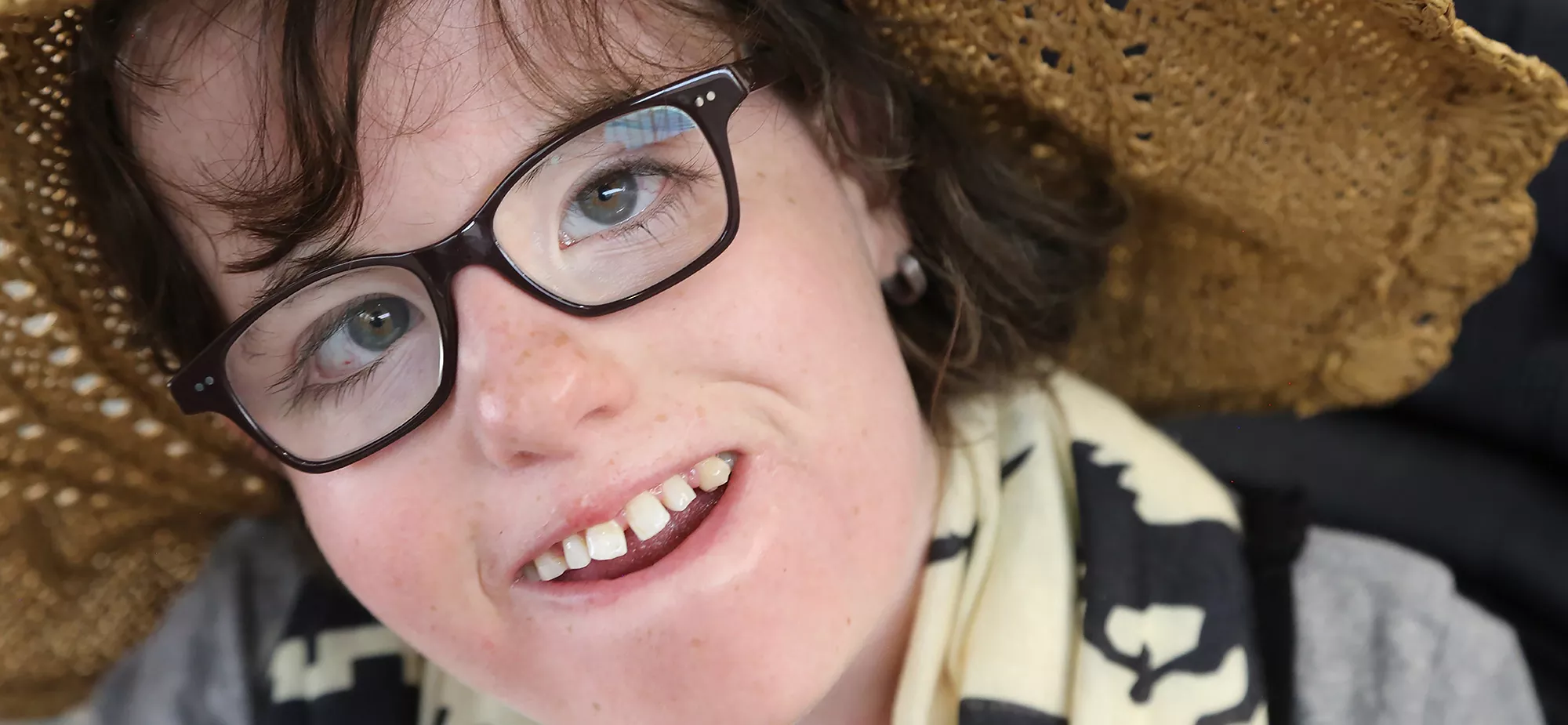 A young woman with Trisomy 18