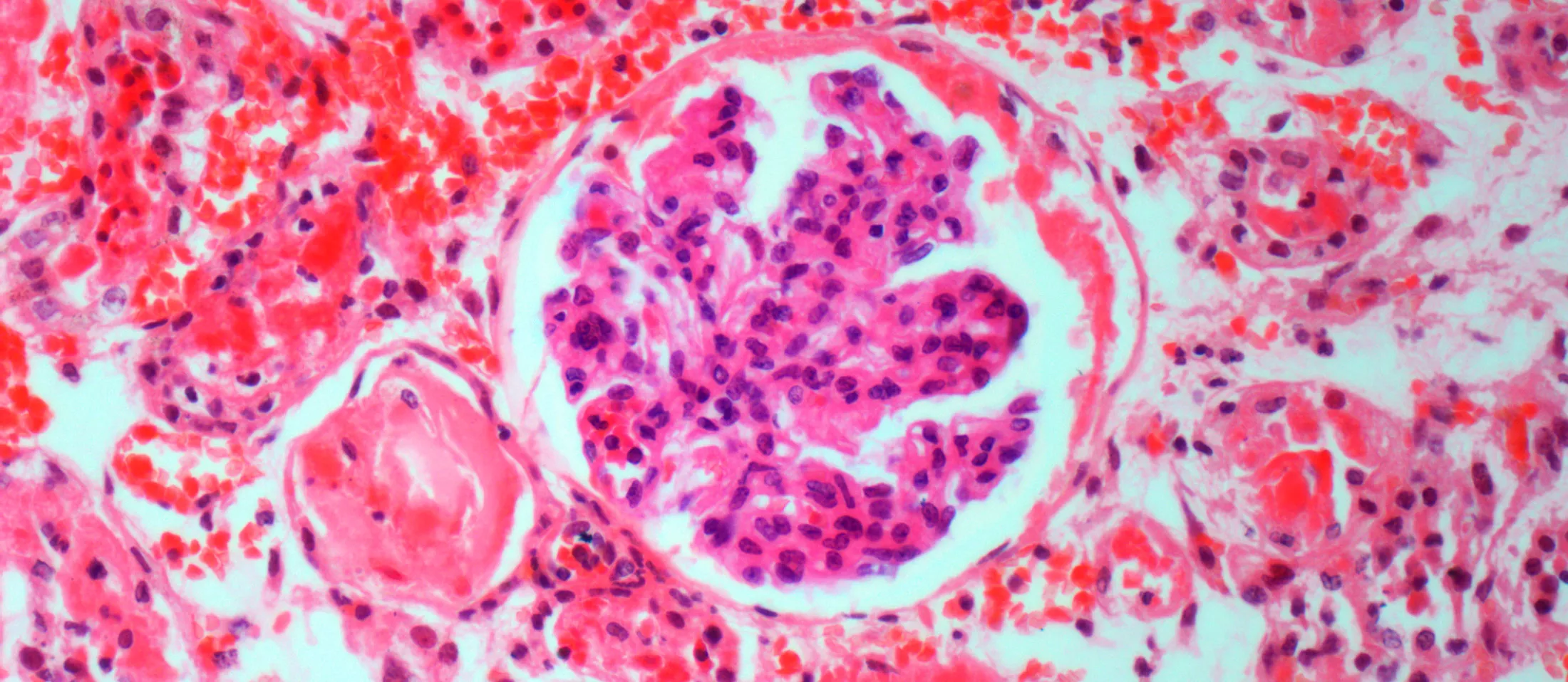 Light micrograph of kidney disease.