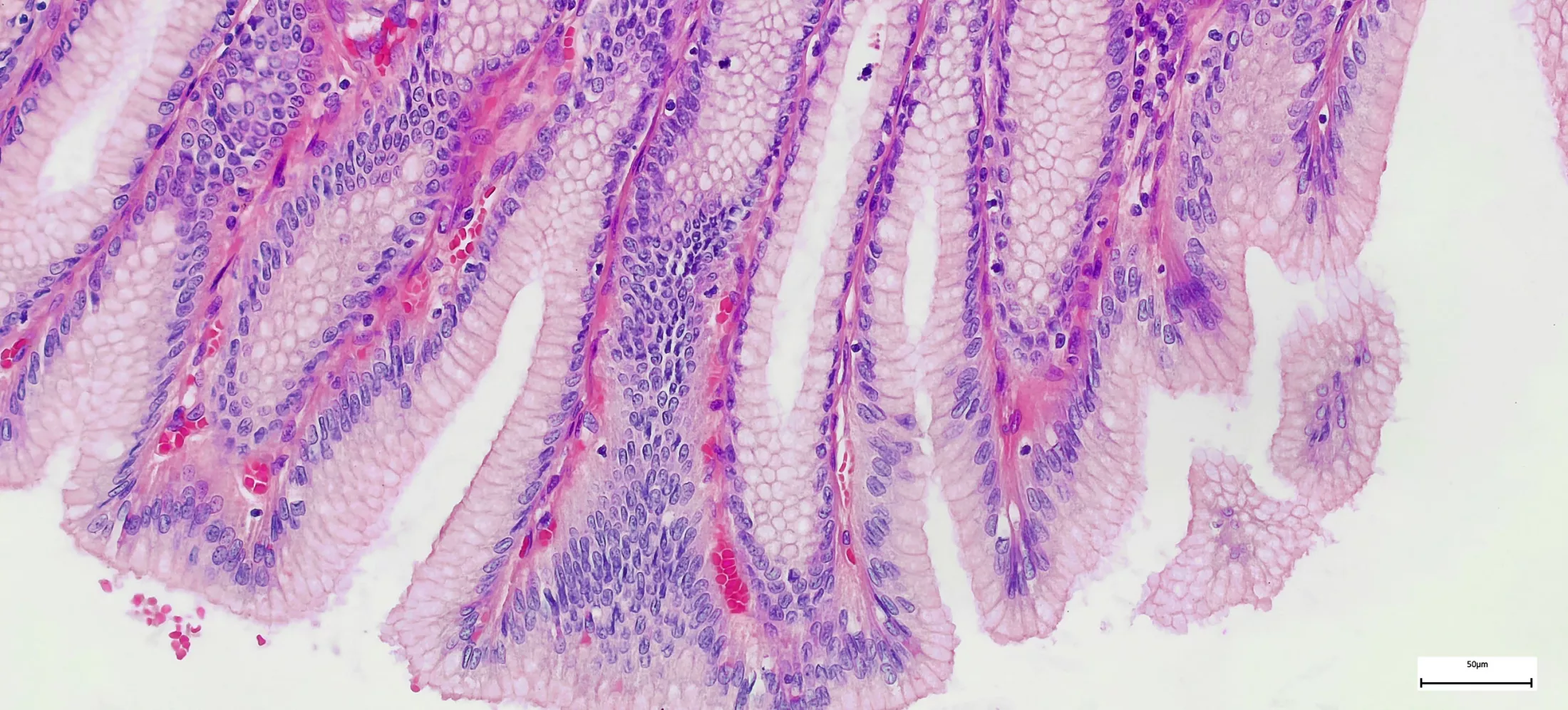 Microscope of Adenoid cystic carcinoma, rare type of cancer exist in many different body sites. 