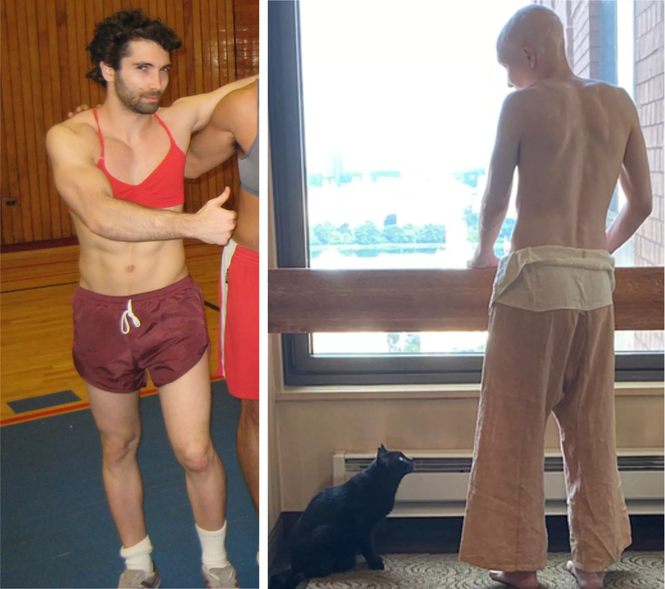 Dr. Mulvey’s undiagnosed rare disease progression over time. 