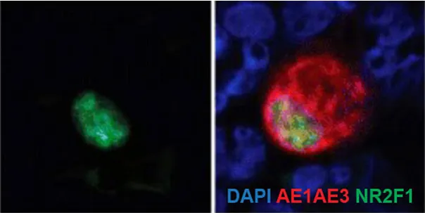 DCCs in the bone marrow of breast cancer patient