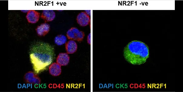 CTC detection in the blood of prostate cancer patient