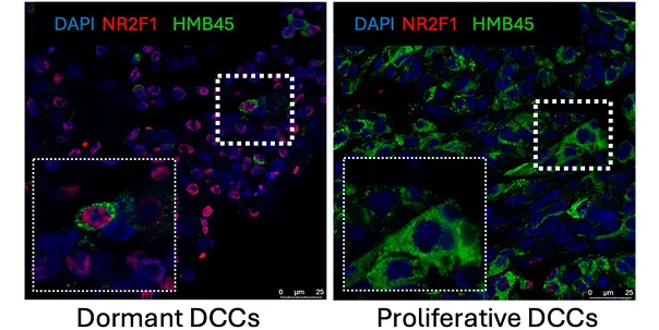 DCCs detection in the liver of uveal melanoma patient.
