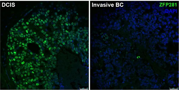 Dormancy marker (ZFP281) expression in breast cancer patients