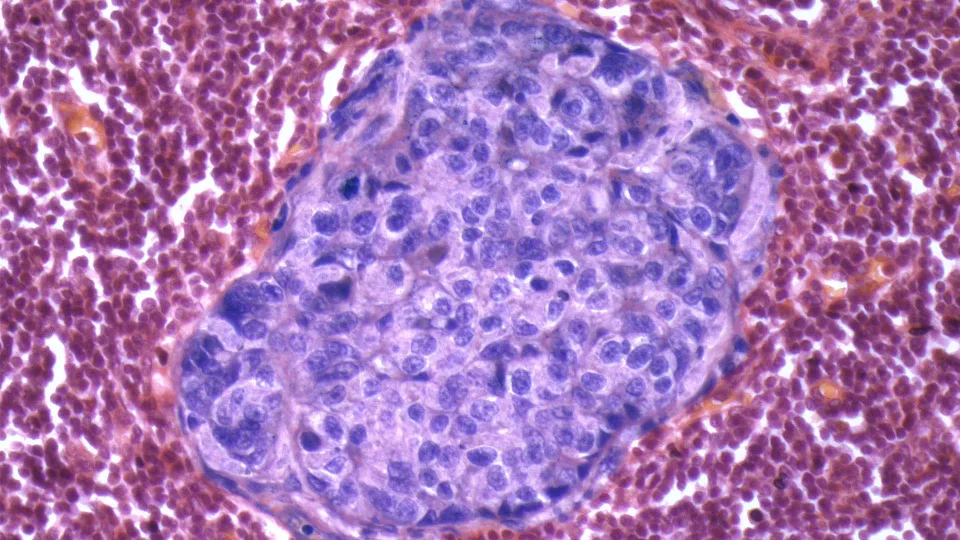 Louis hodgson insights into breast cancer metastasis