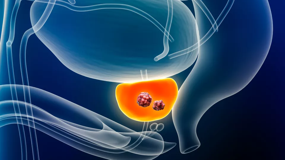 Prostate cancer with organs and tumor or cancerous cells 3D rendering illustration