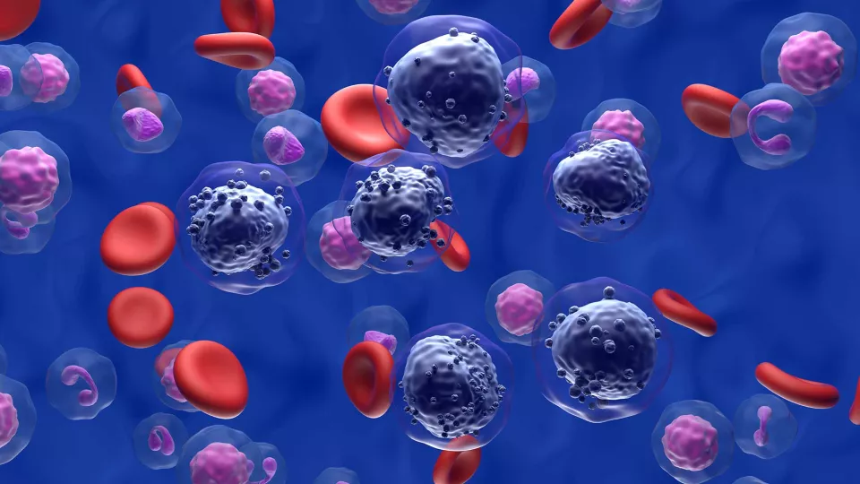 Promising New Therapy for Acute Myeloid Leukemia