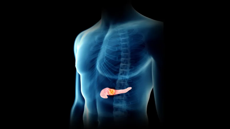 Man's Pancreas Tumor