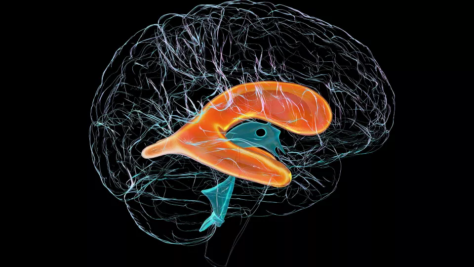 Preventing Hydrocephalus in Premature Infants