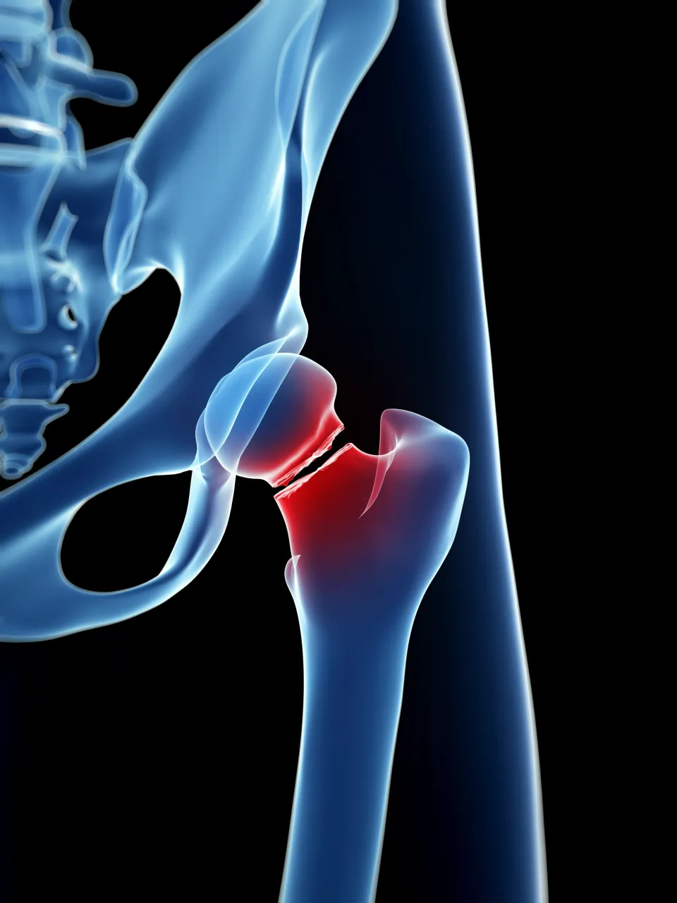 Hip fracture
