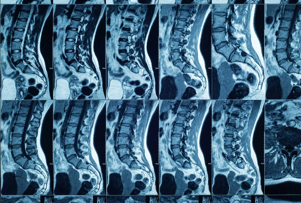 MRI scan showing cross-sections of a spine