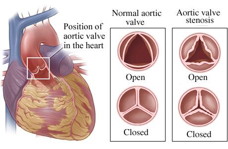 aortic valve image
